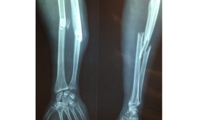 broken bone pixa
